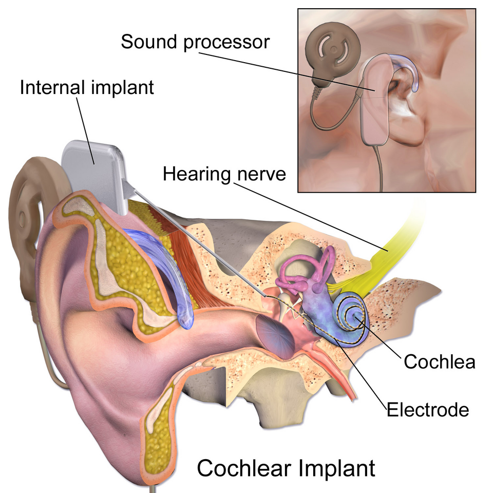 Cochlear Implant System