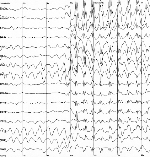 EEG Machine