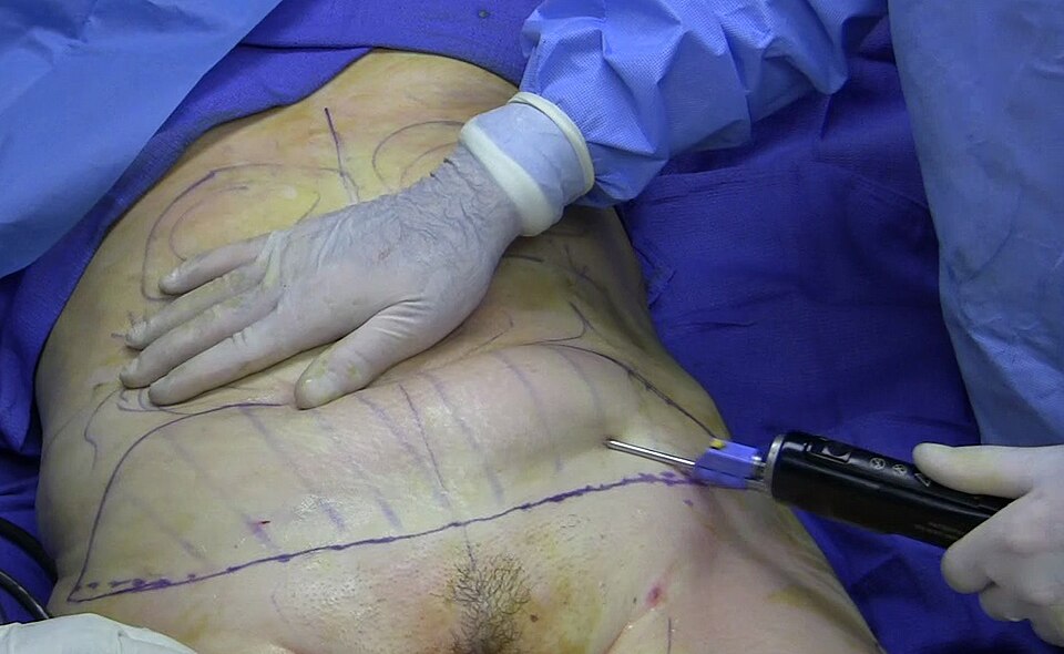Surgical Suction Unit
