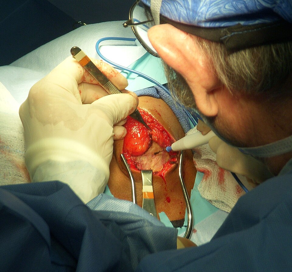 Surgical Smoke Evacuator