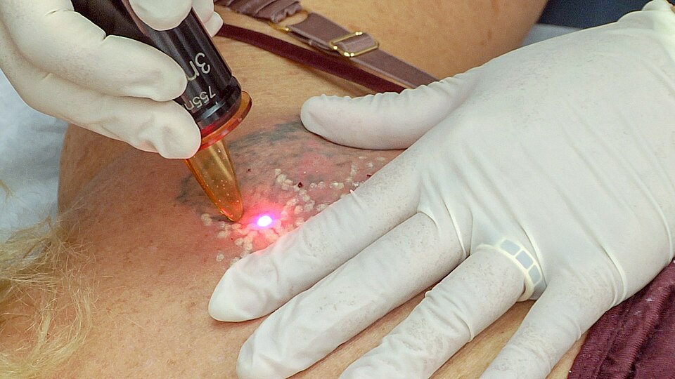 Tattoo Removal Laser